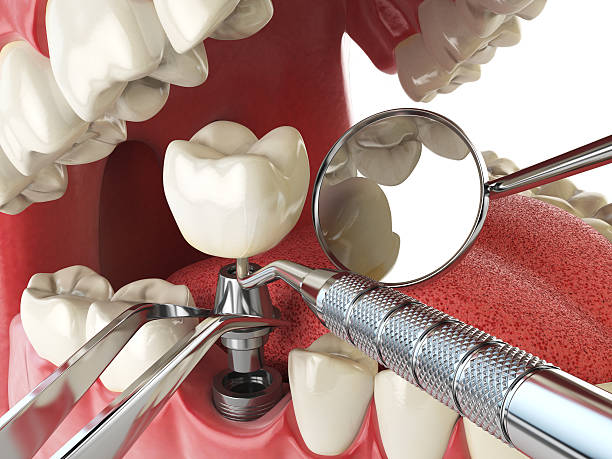 Best Broken or Cracked Tooth Emergency Dentist in Kimball, TN